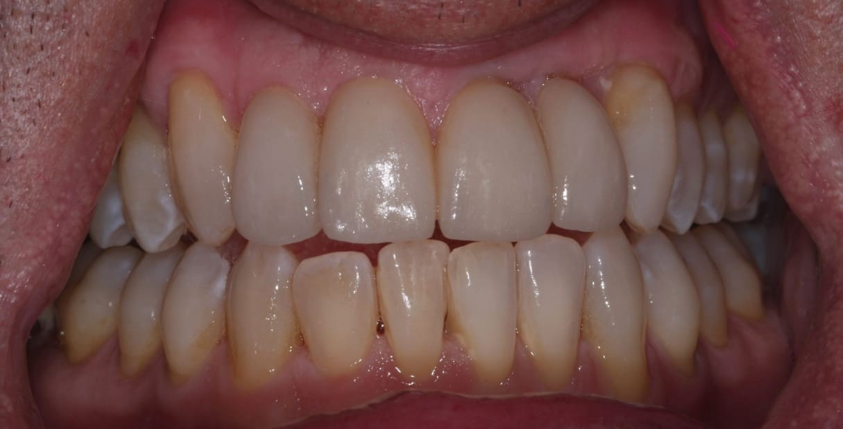 4 Veneers and a Brand New Smile