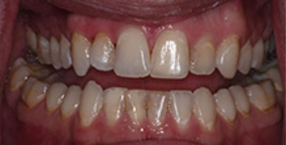 6 Veneers and a New Smile