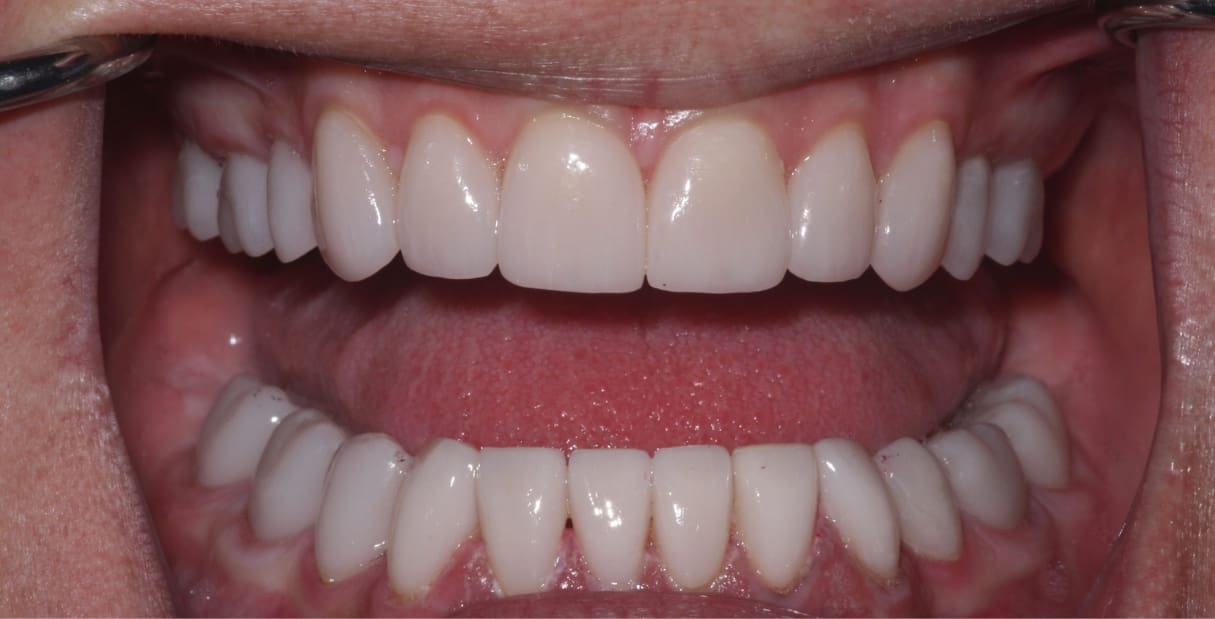 Crowns and Veneers for a Beautiful Smile