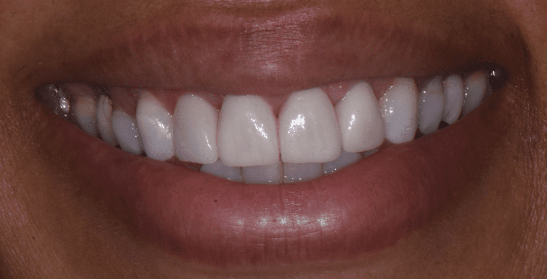 Veneers Create a Perfect New Smile 